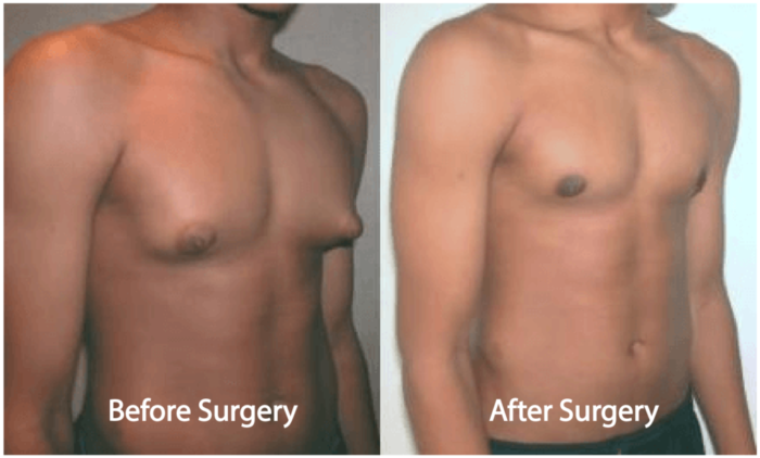 Man Boobs Plastic Surgery