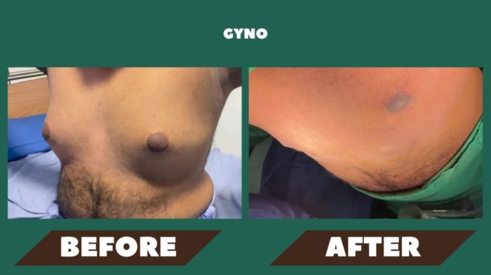 Gyno-before-and-after