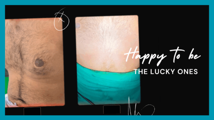 gyno before and after Kandy